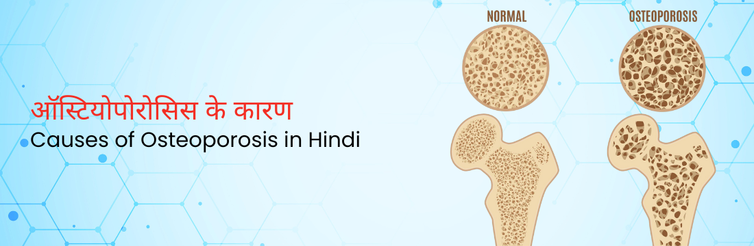 ऑस्टियोपोरोसिस के कारण